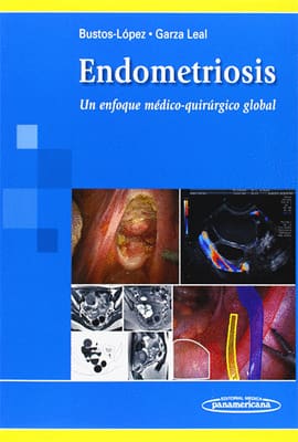ENDOMETRIOSIS. Un Enfoque Médico-Quirúrgico Global