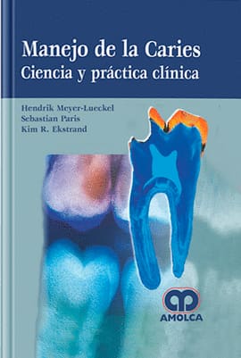 MANEJO DE LA CARIES. Ciencia y Práctica Clínica